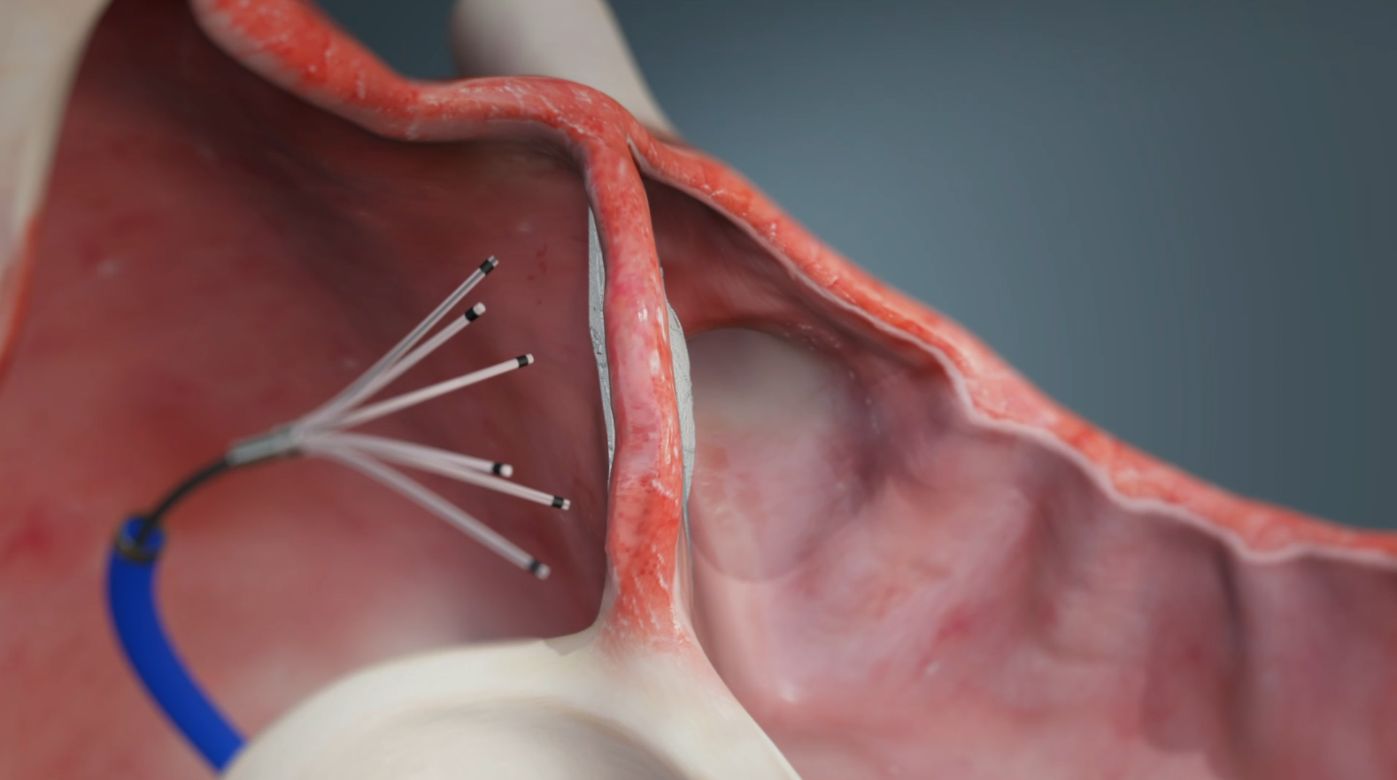 Preclinical Precision Enables First-in-Human Trials for Recross Cardio's Novel PFO Sealing Technology